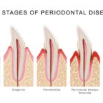 stages of gum disease or periodontal disease