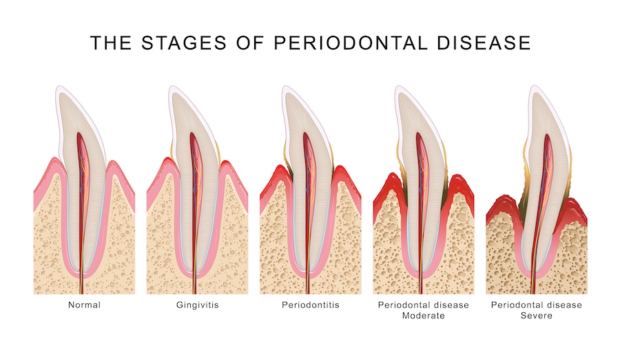 stages of gum disease or periodontal disease