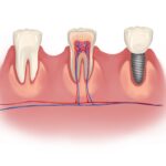 dental implants vs natural tooth