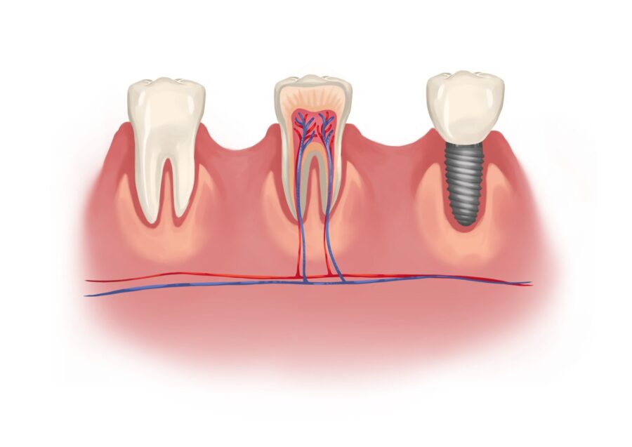 dental implants vs natural tooth