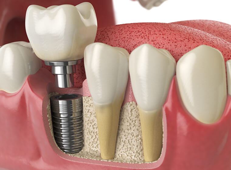 illustration of a dental implant