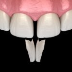 cosmetic dentistry can fix stained teeth, gaps in teeth, chipped teeth, image of diastema on front teeth