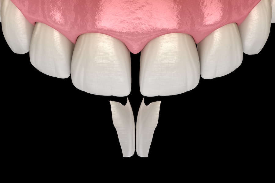 cosmetic dentistry can fix stained teeth, gaps in teeth, chipped teeth, image of diastema on front teeth
