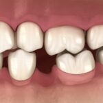 teeth shifting around missing tooth, Popov Godon phenomenon