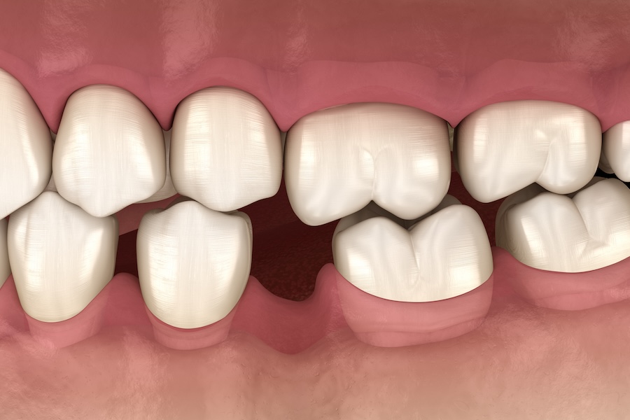 teeth shifting around missing tooth, Popov Godon phenomenon