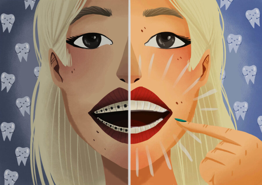 invisalign clear aligners vs traditional braces