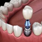 dental implants vs partial denture for missing teeth