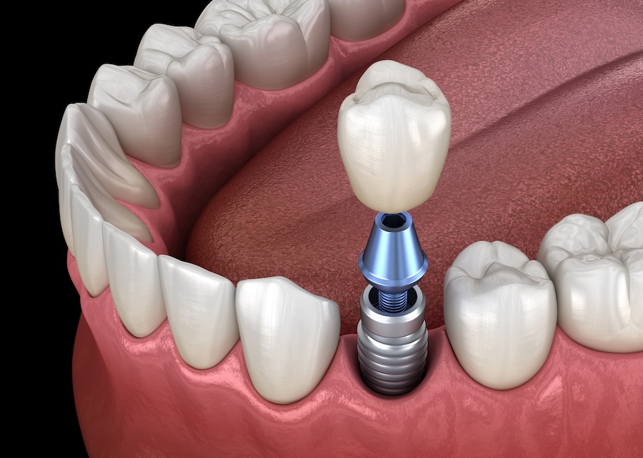 dental implants vs partial denture for missing teeth
