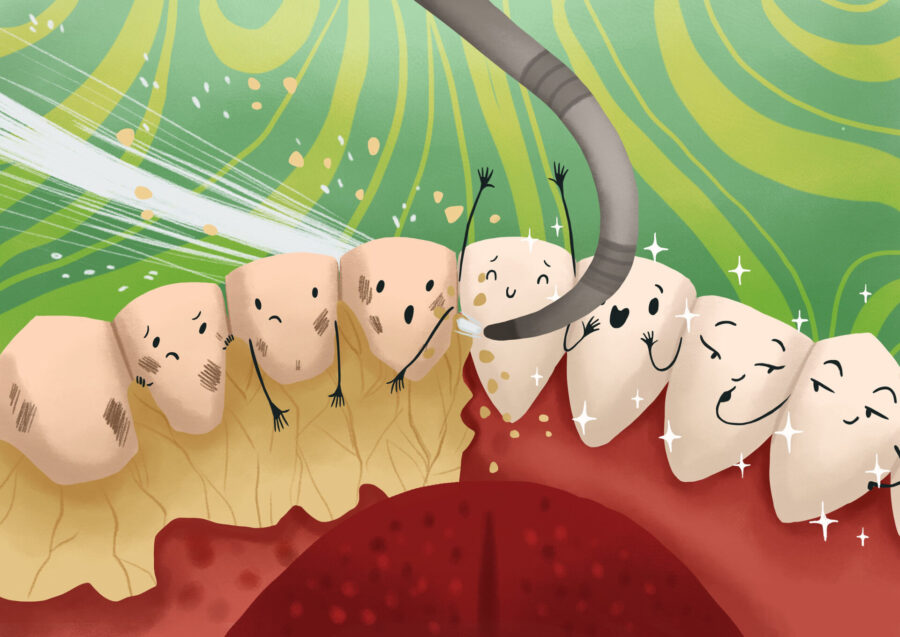 deep cleaning removing bacteria deposits, plaque, tartar, gum disease
