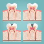 dental cavity formation