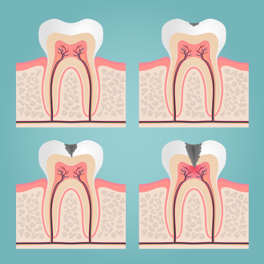 dental cavity formation